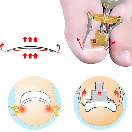 Kit de traitement professionnel pour ongles incarnés avec patchs de correction et outils de pédicure